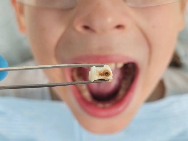 Best Emergency Tooth Extraction in Anton, TX